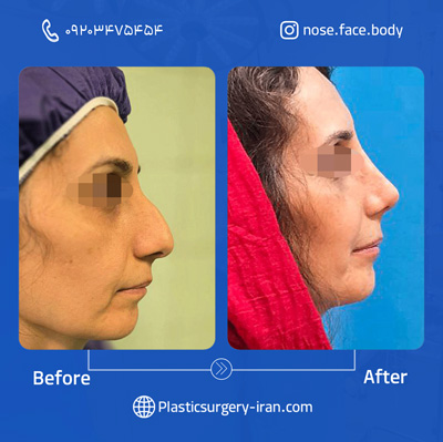 نمونه عمل بینی