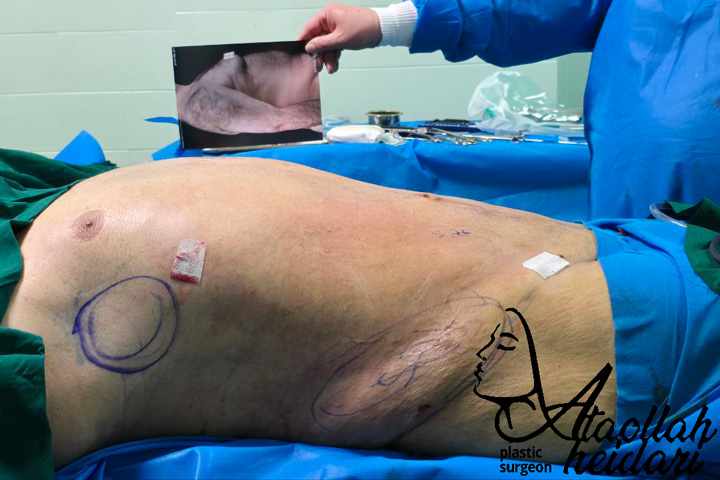 نمونه عمل ژنیکوماستی