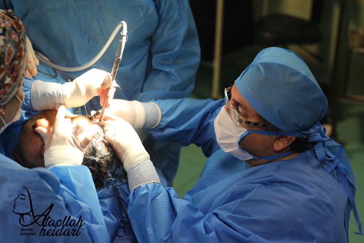 دکتر عطا حیدری در حین عمل لیفت صورت