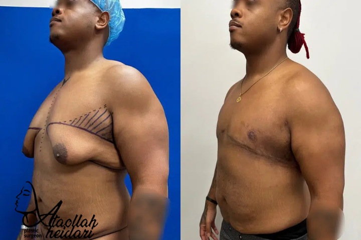 عمل ژنیکوماستی