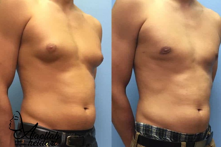 مزایای عمل ژنیکوماستی