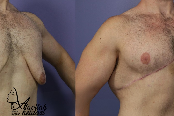 جای بخیه عمل ژنیکوماستی