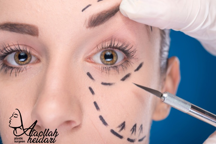 انواع روش های لیفت صورت