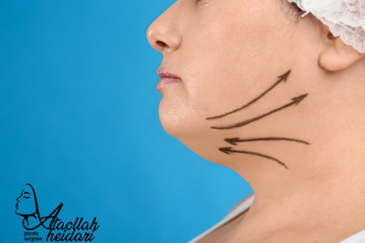 عوارض جراحی لیفت صورت