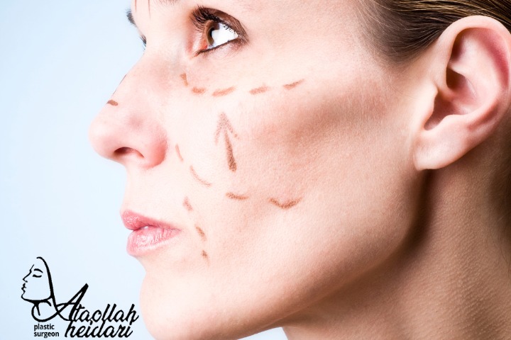 روشهای جراحی لیفت صورت