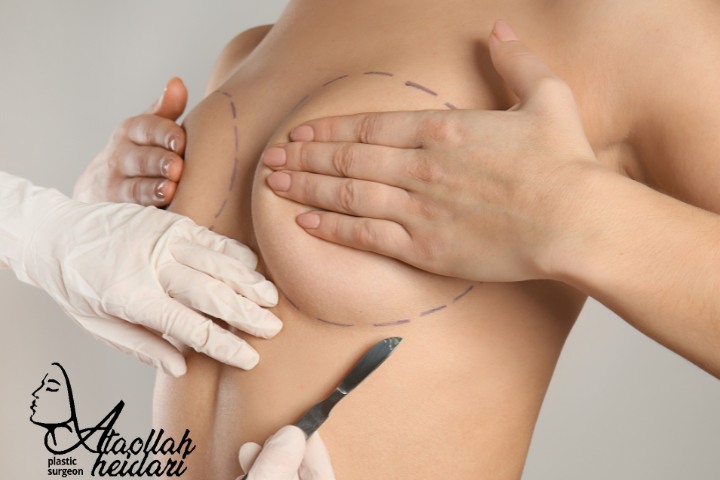 ایمپلنت سینه