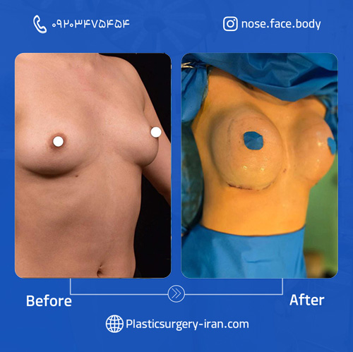 نمونه عمل پروتز سینه