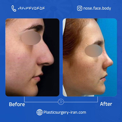 نمونه عمل رینوپلاستی