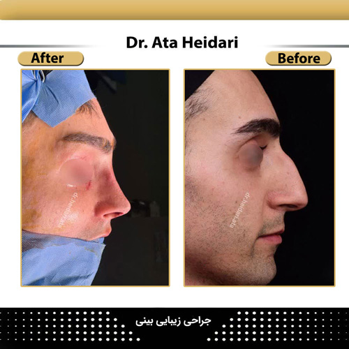 نمونه عمل بینی