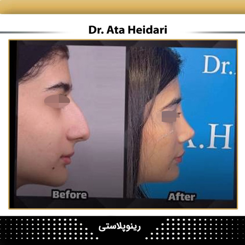 نمونه عمل رینوپلاستی