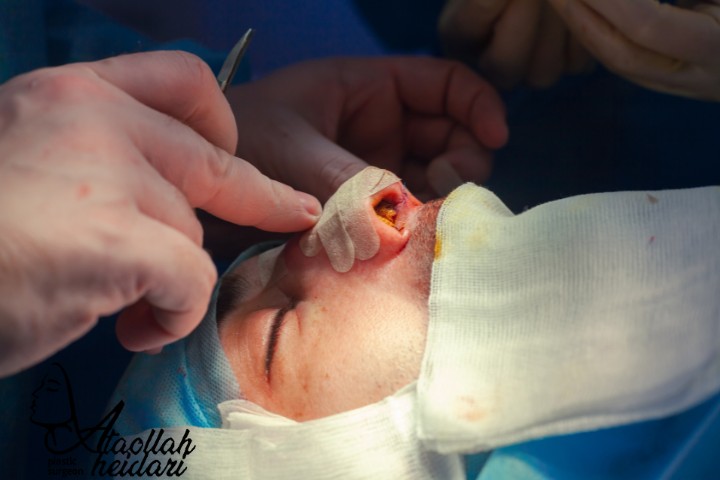 بهترین دکتر عمل بینی