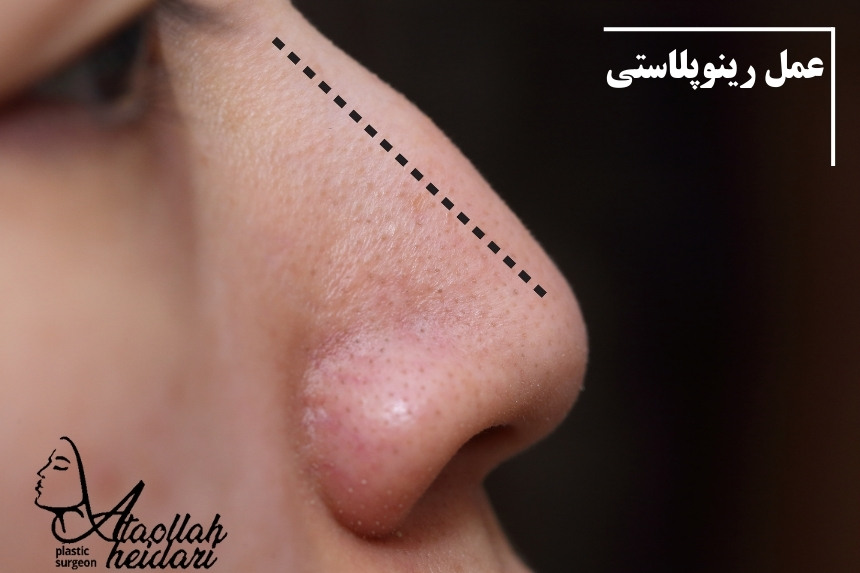 عمل رینوپلاستی چیست