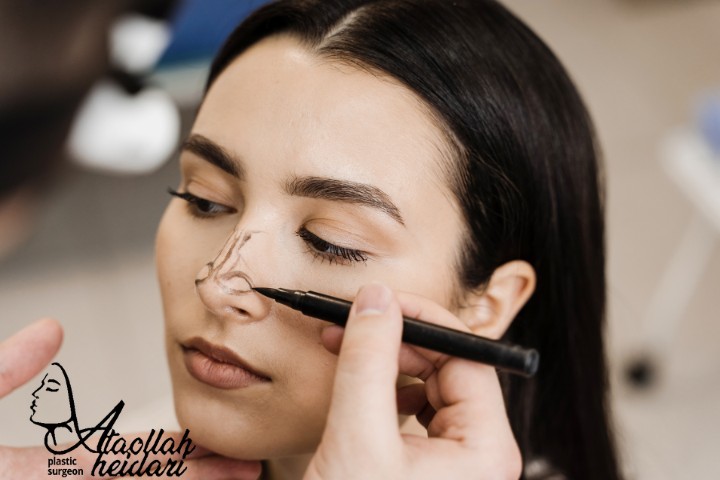 عمل رینوپلاستی بینی استخوانی