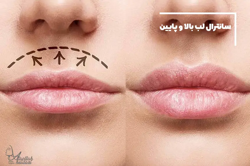 0 تا 100 عمل سانترال لب بالا و پایین