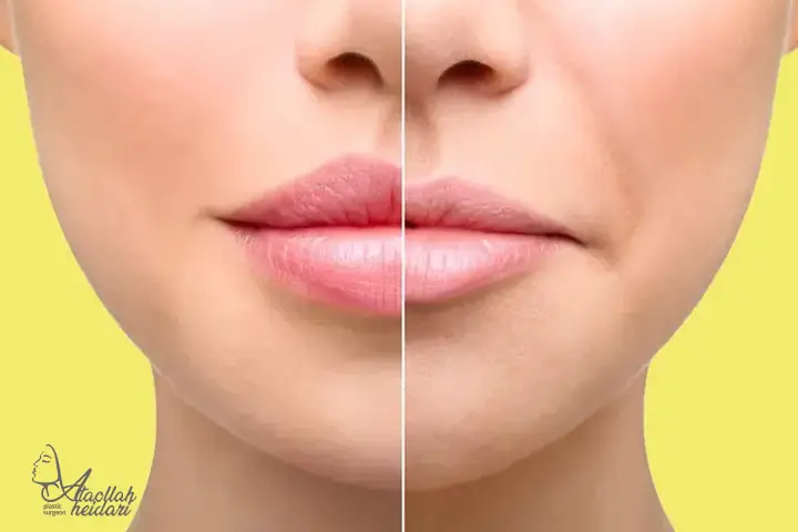 مزایای عمل سانترال لب