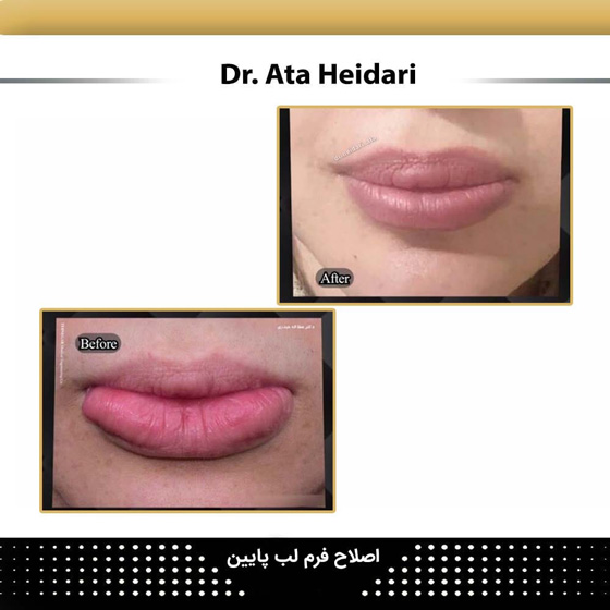 سانترال لب پایین