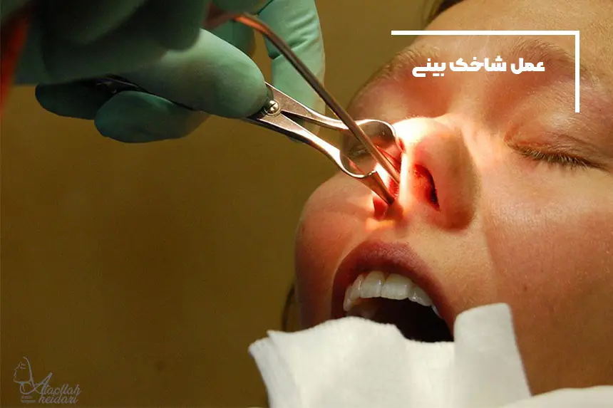 عمل شاخک بینی