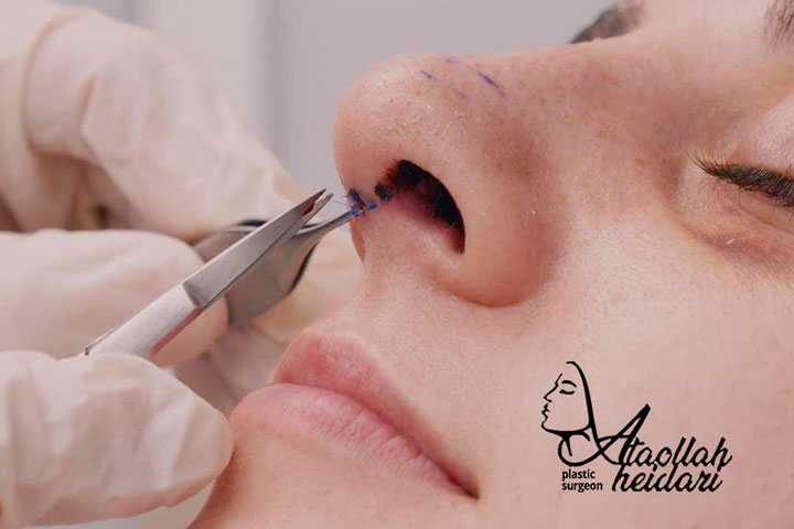 فعالیت های مجاز و ممنوع روز اول عمل بینی