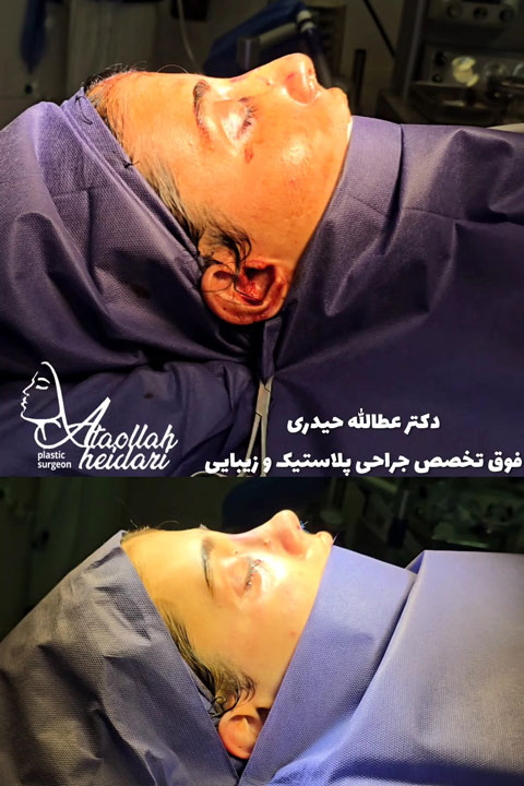 ساعات اولیه بعد از عمل بینی