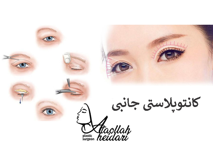 جراحی کانتوپلاستی جانبی