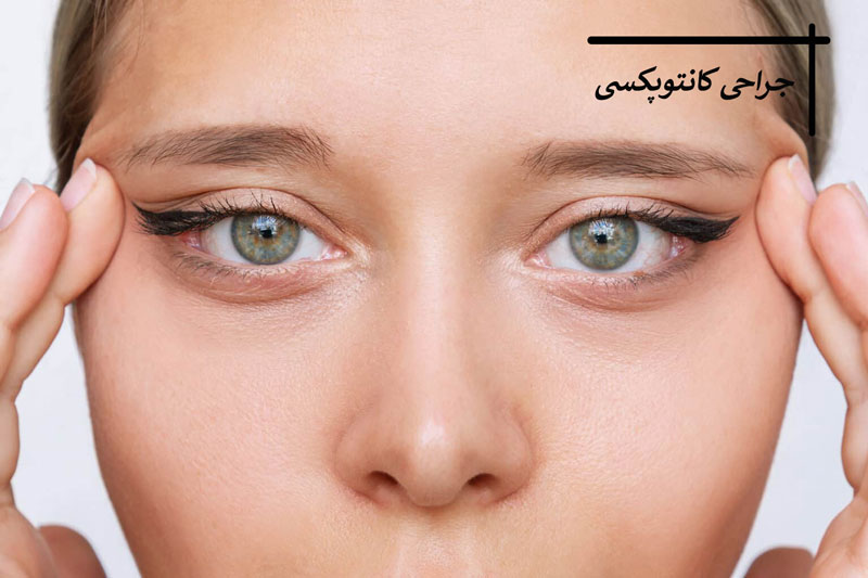 همه چیز درباره عمل کانتوپکسی
