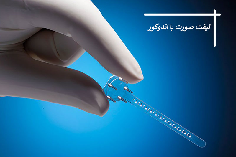 لیفت گونه با اندوکور
